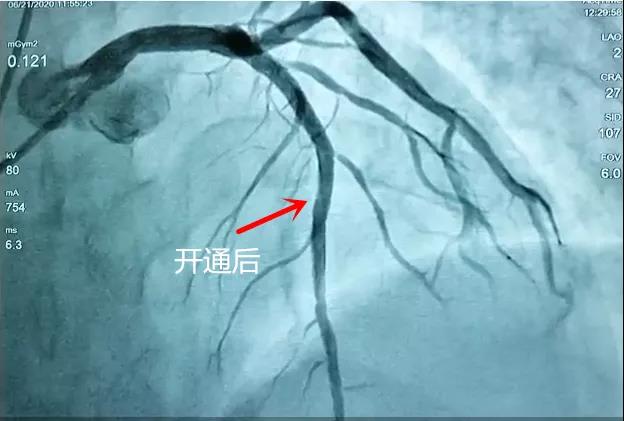 胸痛中心上演生死时速，挽救患者生命！